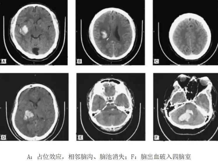 认识这几种头颅 CT，值夜班稳了