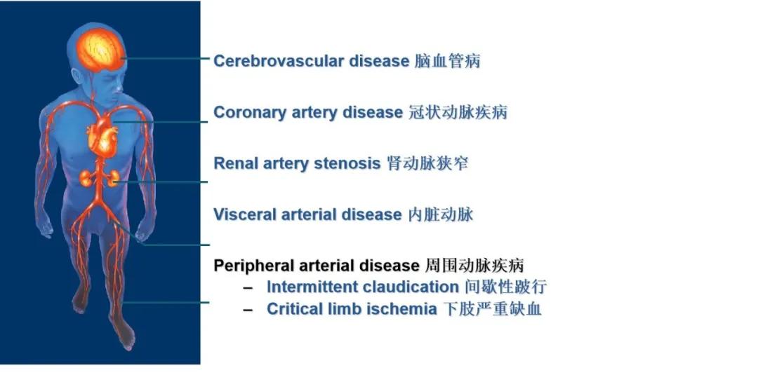 与血管疾病的斗争，多普勒超声血流仪——值得信赖的“武器