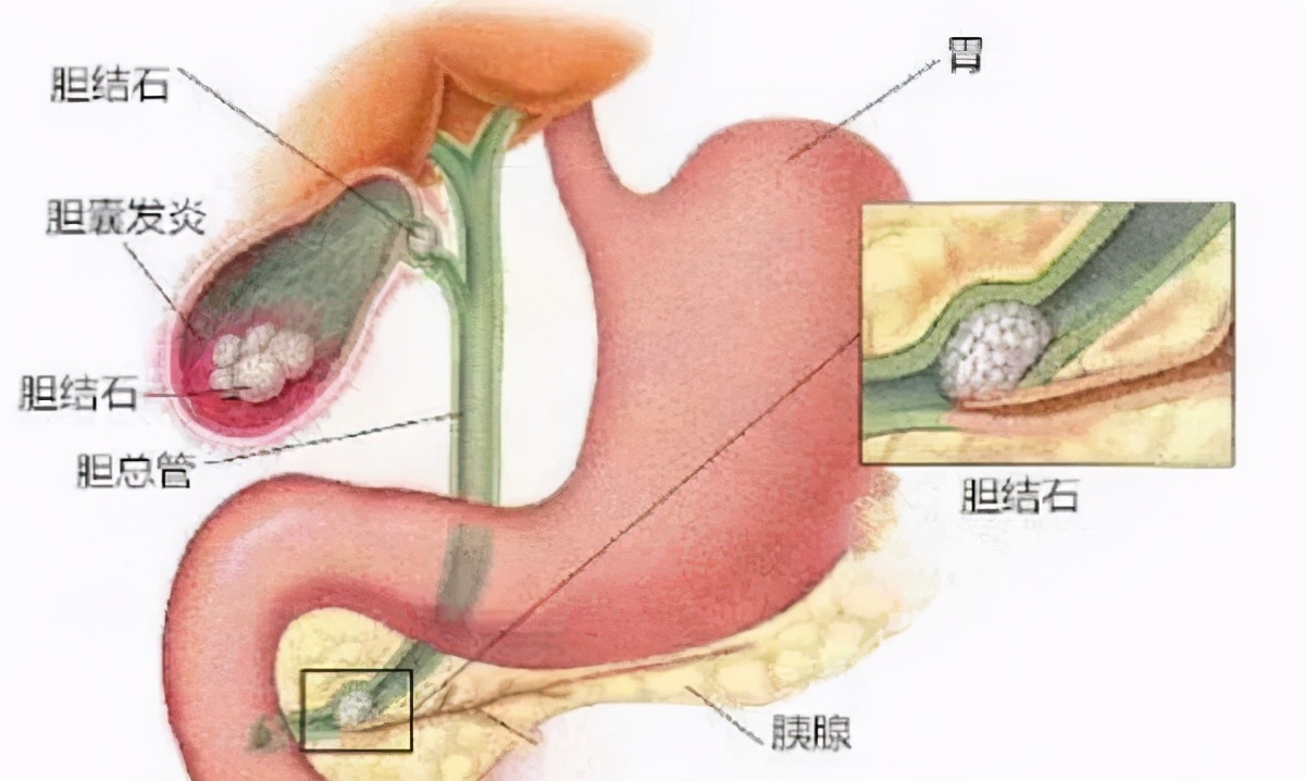 带你一分钟了解胆囊炎还不赶紧学起来 肝胆结石科何明刚 Mdeditor