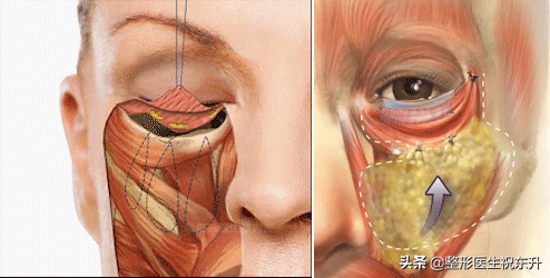 40岁左右，有眼袋、轻度法令纹，更适合做眼袋切口面中部提升