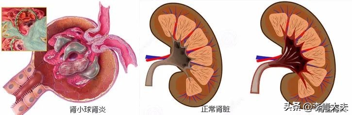 為“敗火”生吃一個魚膽，結果被血透
