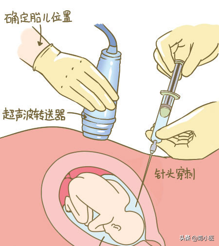 羊水穿刺10分钟，提心吊胆两个月，原来就跟挠痒痒一样......