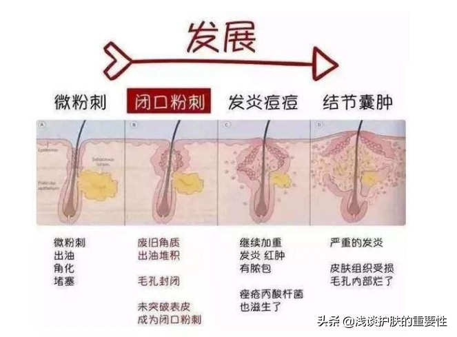 油痘肌夏日生存指南，讓你30s了解並KO它