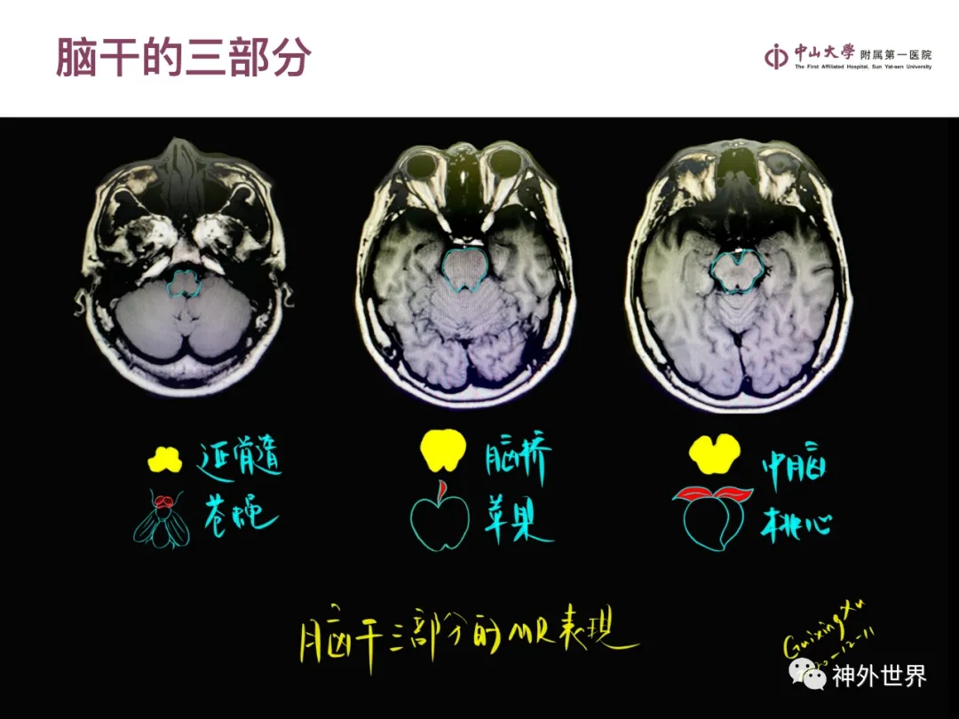最全影像总结 | 颅内病变 MR、CT 的阅片技巧，太赞了