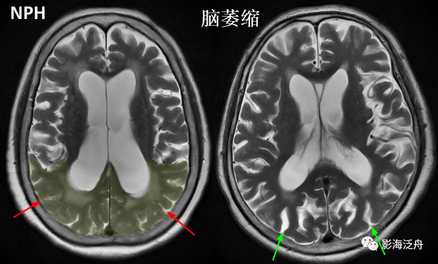 小心误诊，这可不是单纯的脑萎缩