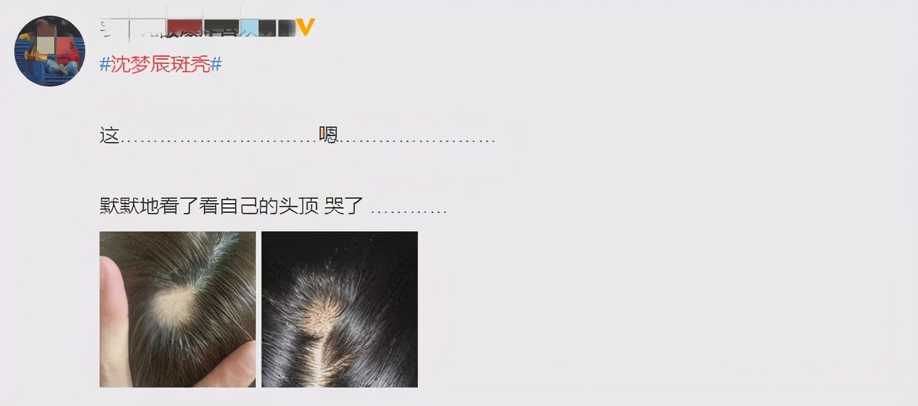 沈夢辰突然斑禿上熱搜！傳說中的"鬼剃頭"盯上年輕人，很多人還蒙在鼓里…