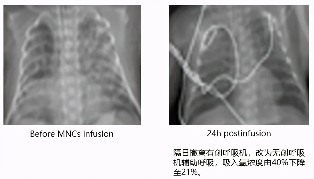 陈佳教授：脐带血治疗支气管肺发育不良新生儿的应用进展