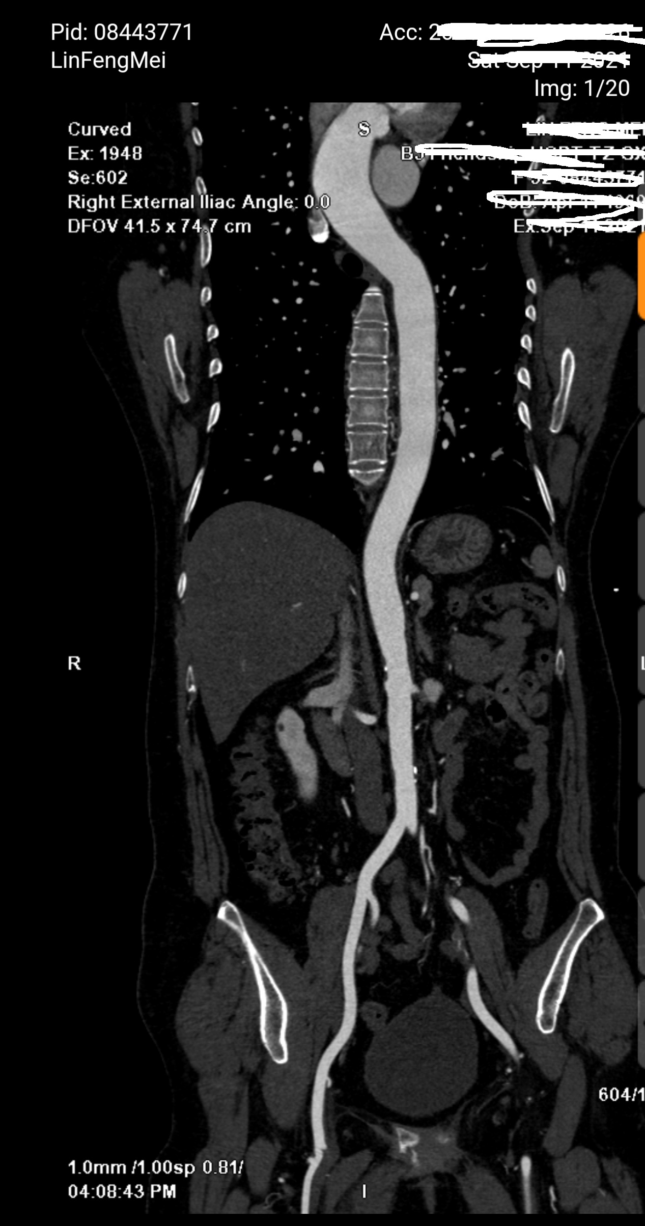 52岁女性为什么就出现这么严重的心脏病变