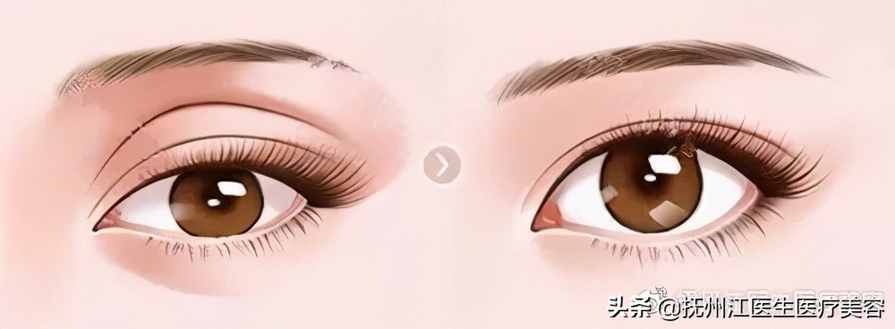 雙眼皮修復的10個常見問題 幫你避免二次手術 撫州江醫生醫療美容 Mdeditor