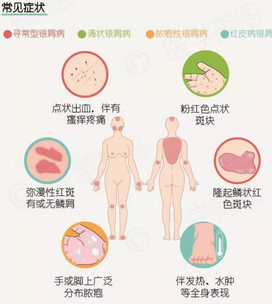 今天是第17个“世界银屑病日”