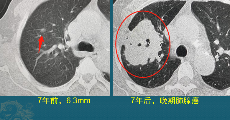 磨玻璃肺结节随访观察，会不会变成肺癌？医生带你看随访4种结局