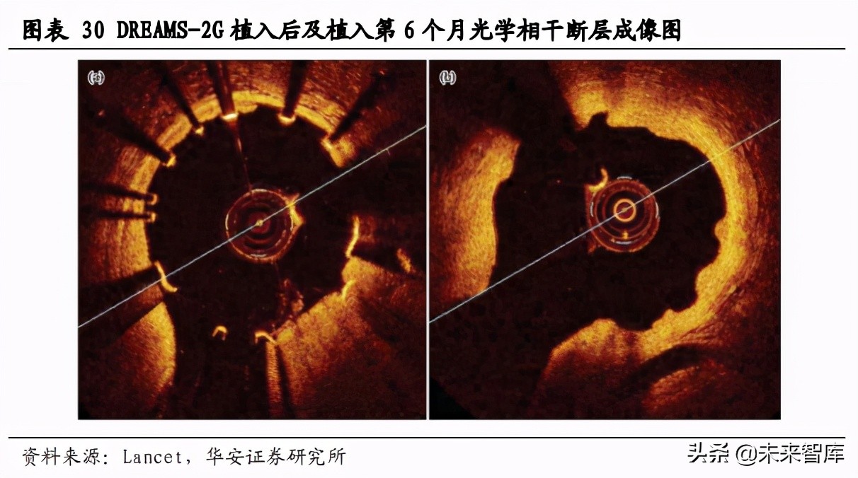 冠脉支架行业研究：拨开集采迷雾，探究冠脉支架方向