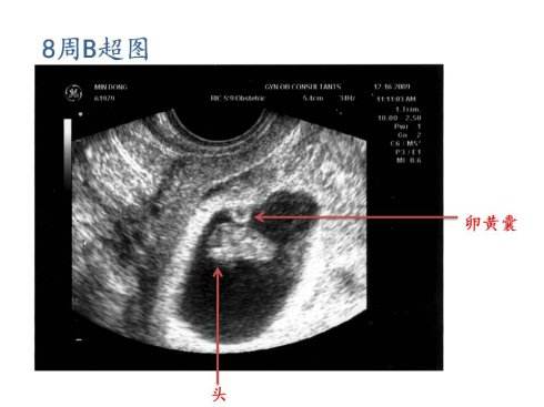 孕早期b超图解,准妈妈需知的7个指标