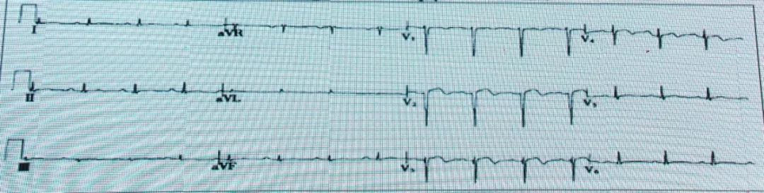 如何从纷繁的ST-T改变中识别高危患者？丨临床解惑