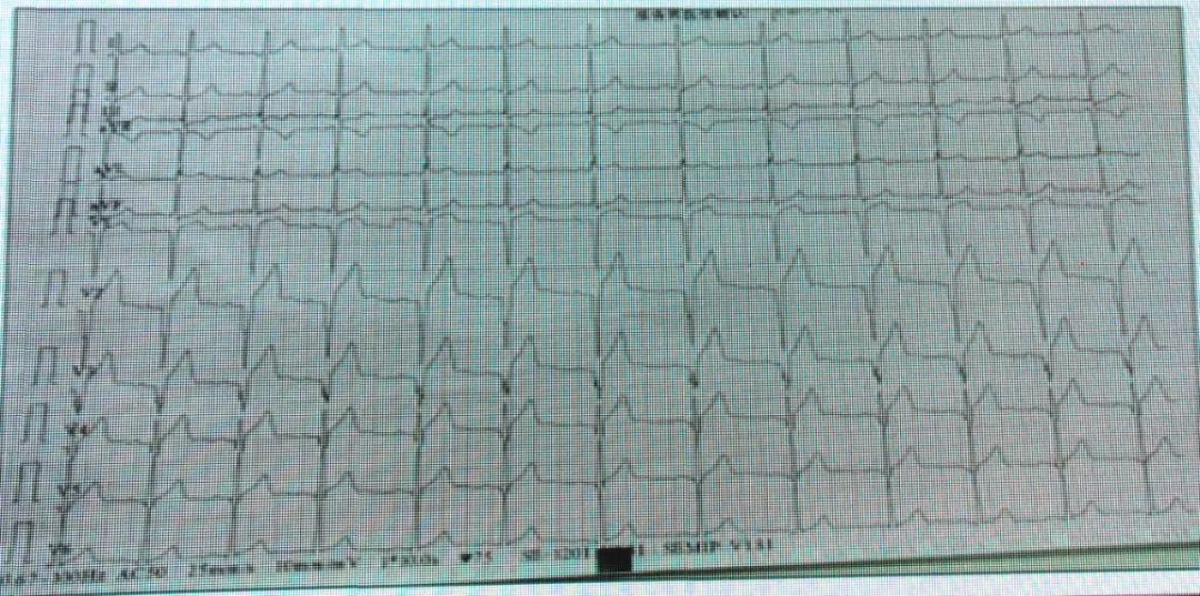 如何从纷繁的ST-T改变中识别高危患者？丨临床解惑