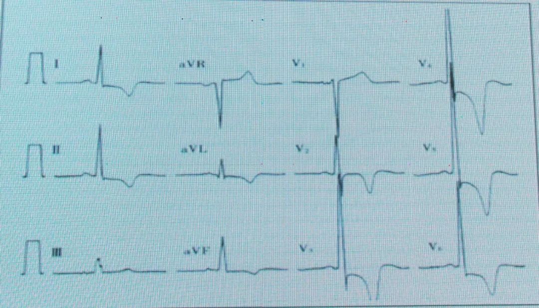 如何从纷繁的ST-T改变中识别高危患者？丨临床解惑