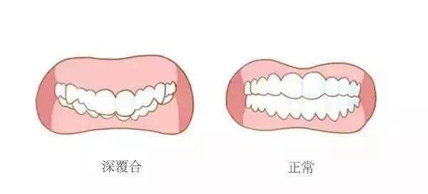 8种要矫正的牙齿畸形，看医前可对照自检