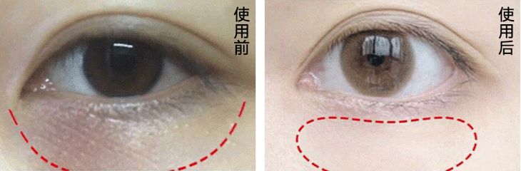 改良自《本草纲目》的护眼良方，眼睛疲惫一贴