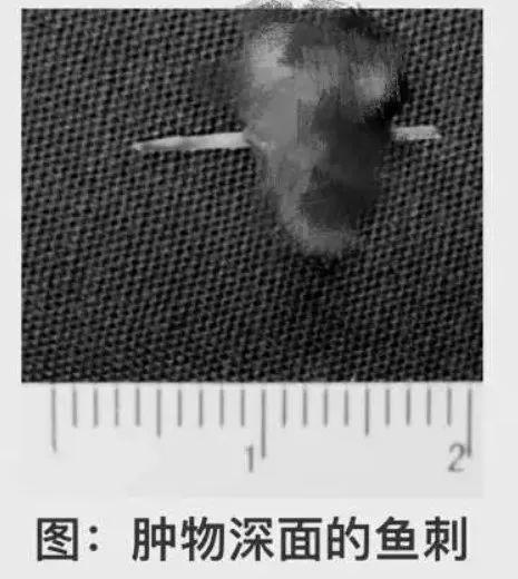 阿姨舌头肿胀险致癌！“罪魁祸首”竟是一根鱼刺