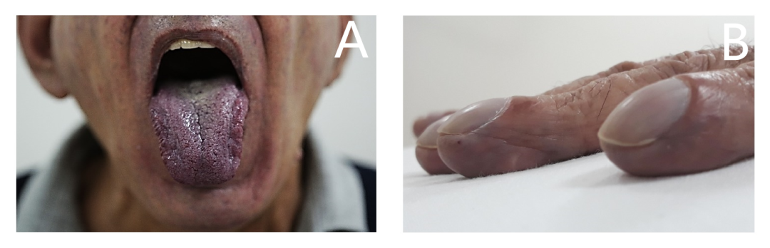 慢性丙肝患者发绀、杵状指，何因所致？｜临床实战