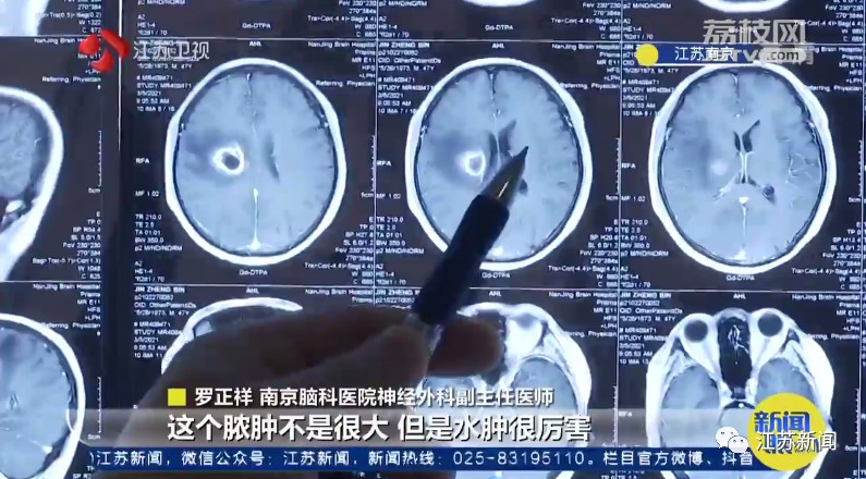 男子挤了颗痘痘，竟然导致上肢瘫痪！这里的痘