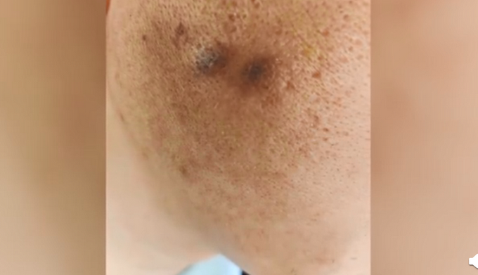 陕西一员工年会被高管烟头烫脸：疼才长记性，