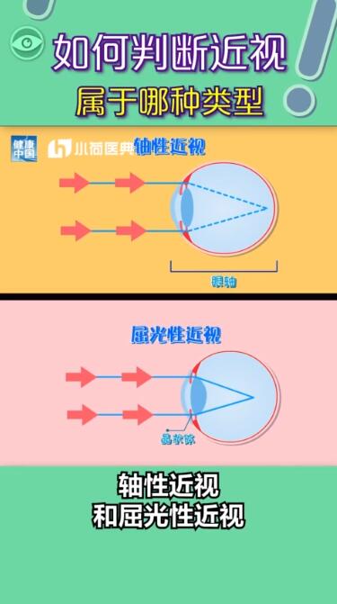 孩子近视都是电子产品惹的祸？近视有没有可能恢复？权威解答在此，值得收藏