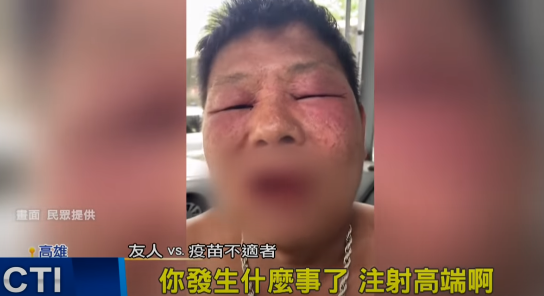 台灣一民眾接種高端疫苗後臉部腫成“豬頭”，島內網友也看呆了
