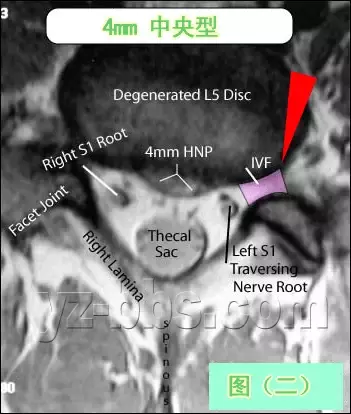 手把手教你：腰椎间盘突出CT和MRI读片技巧