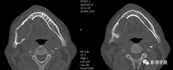 史上超全！颌骨囊性常见病变的CT诊断-《中国CT和MRI杂志》《罕少疾病杂志》