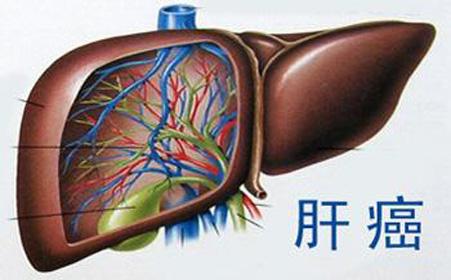 肝胆医生解答：晚期肝癌到底该不该治疗，是不是大家说的人财两空