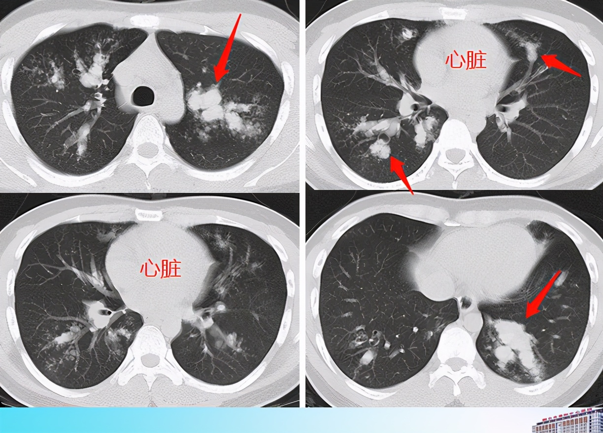 霉菌无处不在，不小心吸进肺里会怎么样？豪大夫趣解肺真菌感染