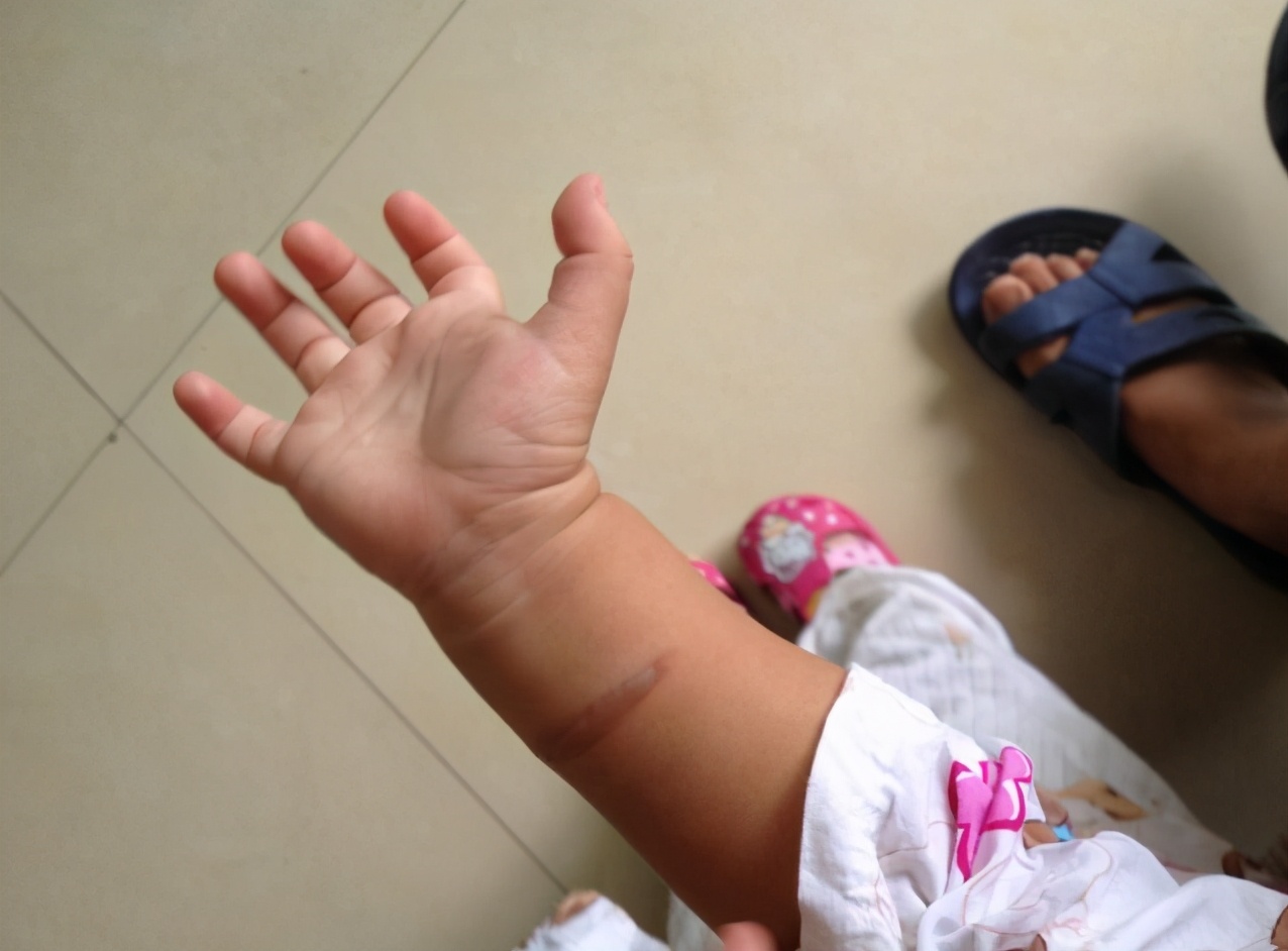 孩子被燙傷怎麼辦？ 事後兩分鐘為黃金救治時間，家長謹記這五步