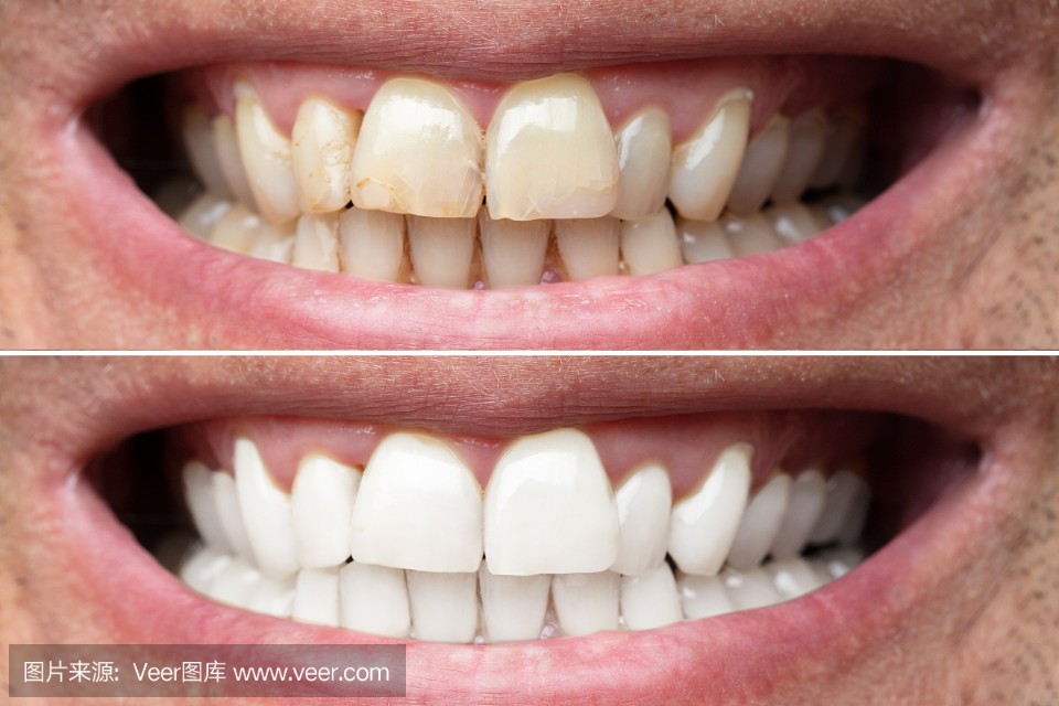 牙齿瓷贴面的优缺点，你知道么？