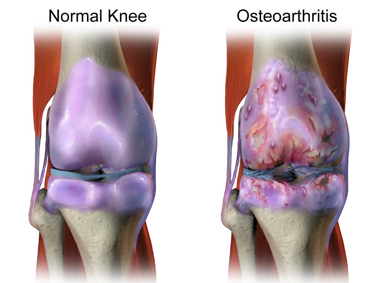 膝關節軟骨損傷的十種原因 個個都可引發骨關節炎 你中了幾個 資訊咖
