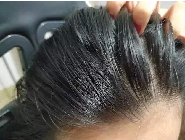 頭髮大把的掉，這4類食物導致脫髮�元兇�，趁早戒掉