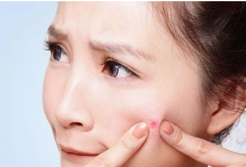 “皮肤有痘印”的女人，再缺钱也要试试这几款精华，助你告别痘印