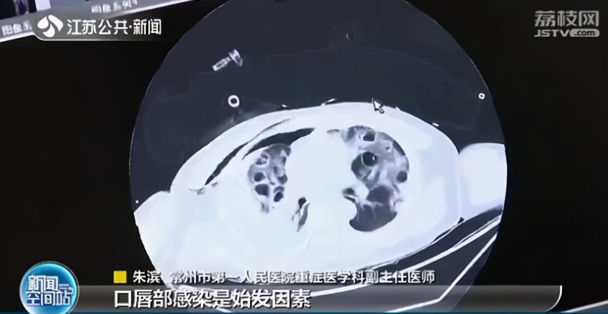 男子挤痘痘引发肺部严重感染 抢救时甚至用上“人工肺”ECMO