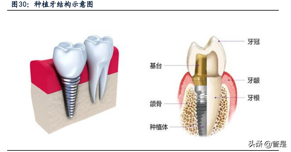 康拓医疗专题报告：神外颅骨修补领域PEEK材料领跑者