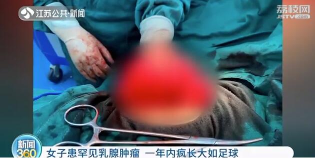 女子患罕见乳腺肿瘤 一年内疯长大如足球