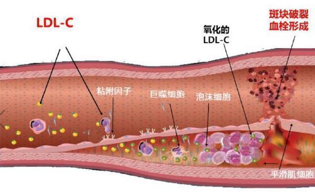 体检发现“颈动脉斑块”？脑科医生为您揭示它的真面目和危害