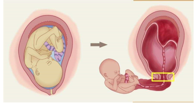 曾因宫颈机能不全妊娠终止，现二胎喜怀双胞胎