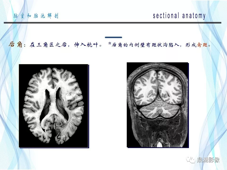 超全详解：脑池和脑室断层解剖