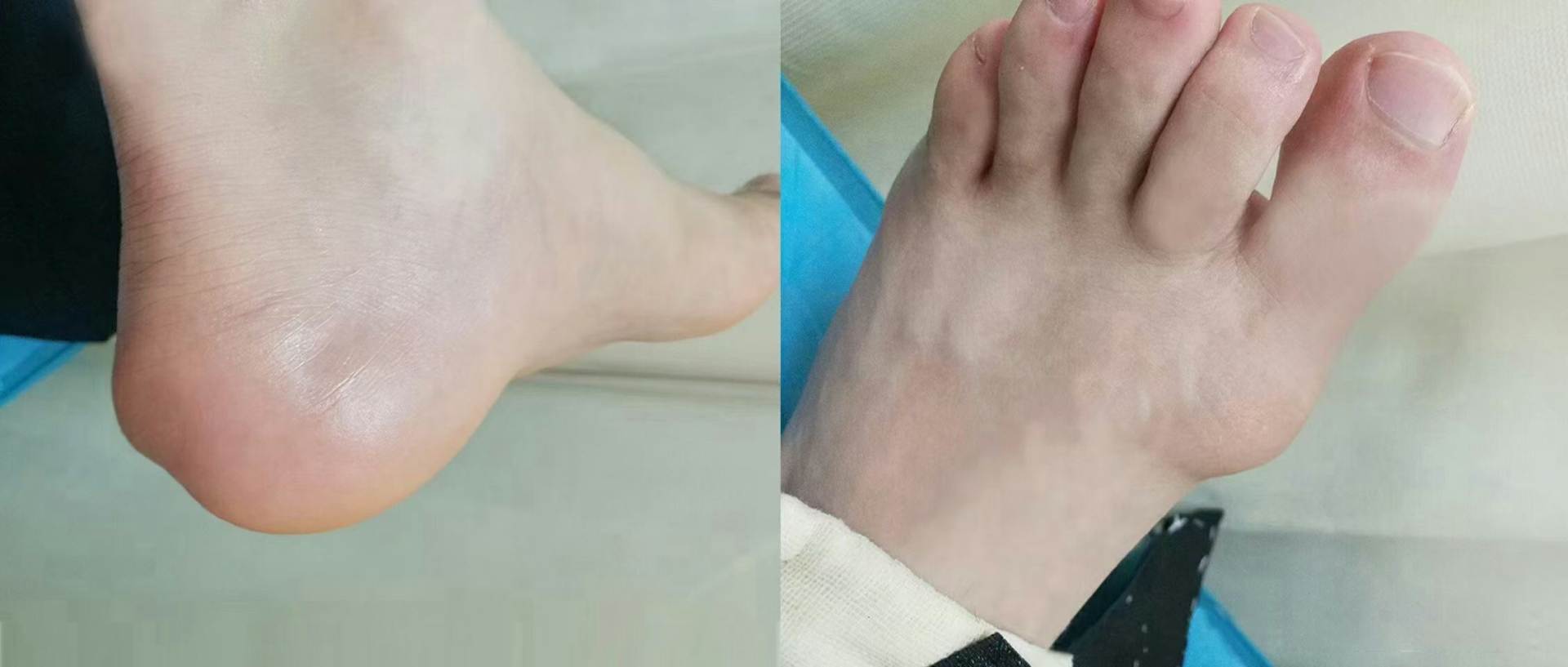 痛風的�自然療法�，安全又有效，你了解嗎