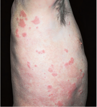 让人烦恼的荨麻疹是什么样的疾病？
