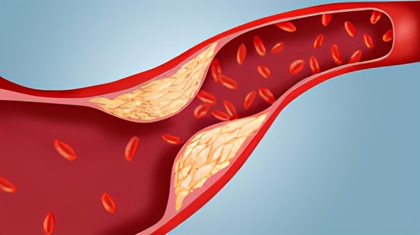 低密度脂蛋白胆固醇升高是什么原因，有什么危害？医生为您讲清楚