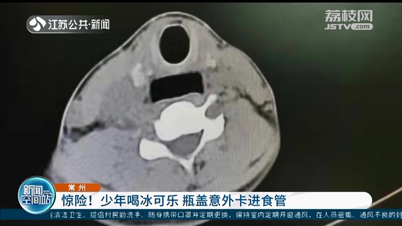 常州少年喝冰可乐，瓶盖意外卡进食管 全麻手术后取出