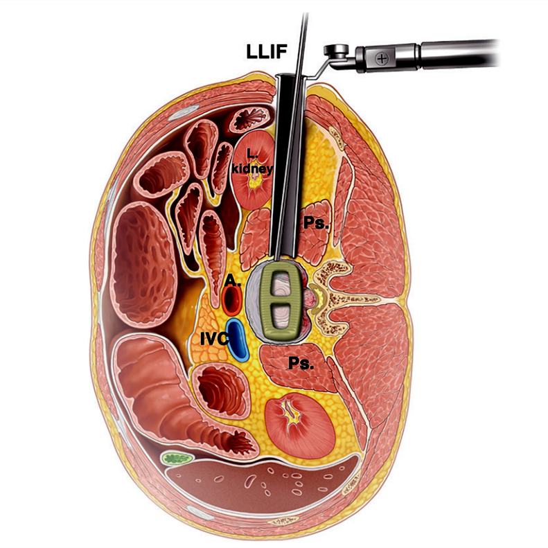 文献查阅 | LLIF-微创外侧腰椎椎体入路的外科血管解剖