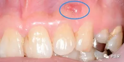 牙龈上长脓包，挤掉后还反复长出，怎么回事？