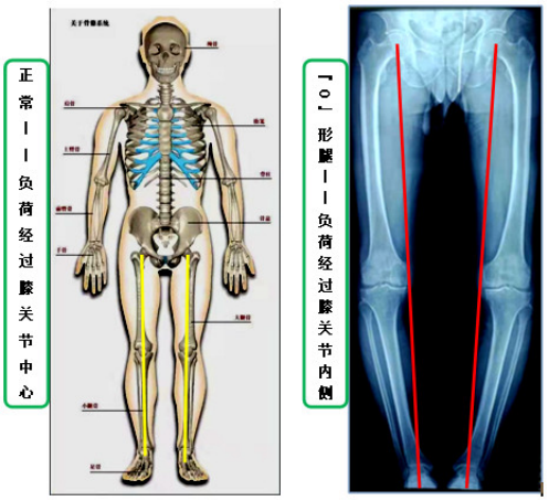 答疑解惑！成年人“O”型腿还能矫正吗？哪些情况需要手术？